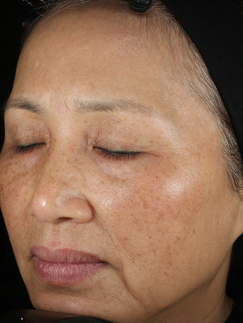 Day 1 of woman before application of Miracle Set.