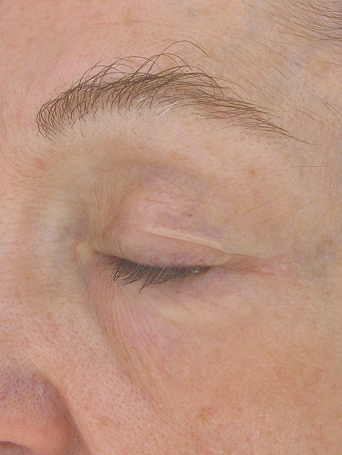 Week 12 of woman after application of Mircale Set.