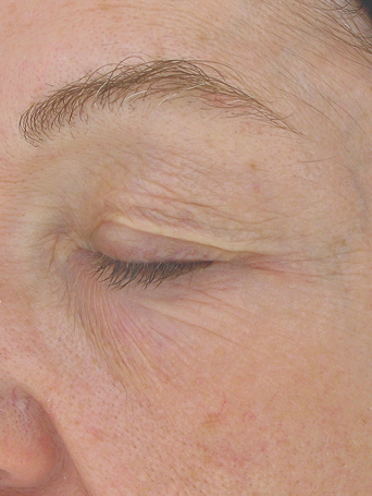 Day 1 of woman before application of Miracle Set.