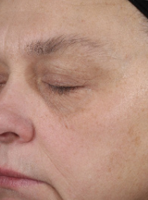 After using Mary Kay Clinical Solutions Retinol 0.3